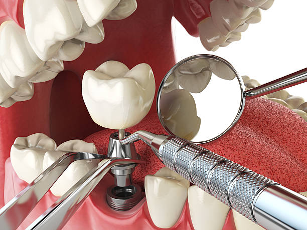 Best Emergency Wisdom Teeth Removal in St James, MN